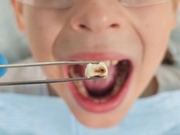 Best Dentist for Tooth Abscess  in Sandy Hook, CT